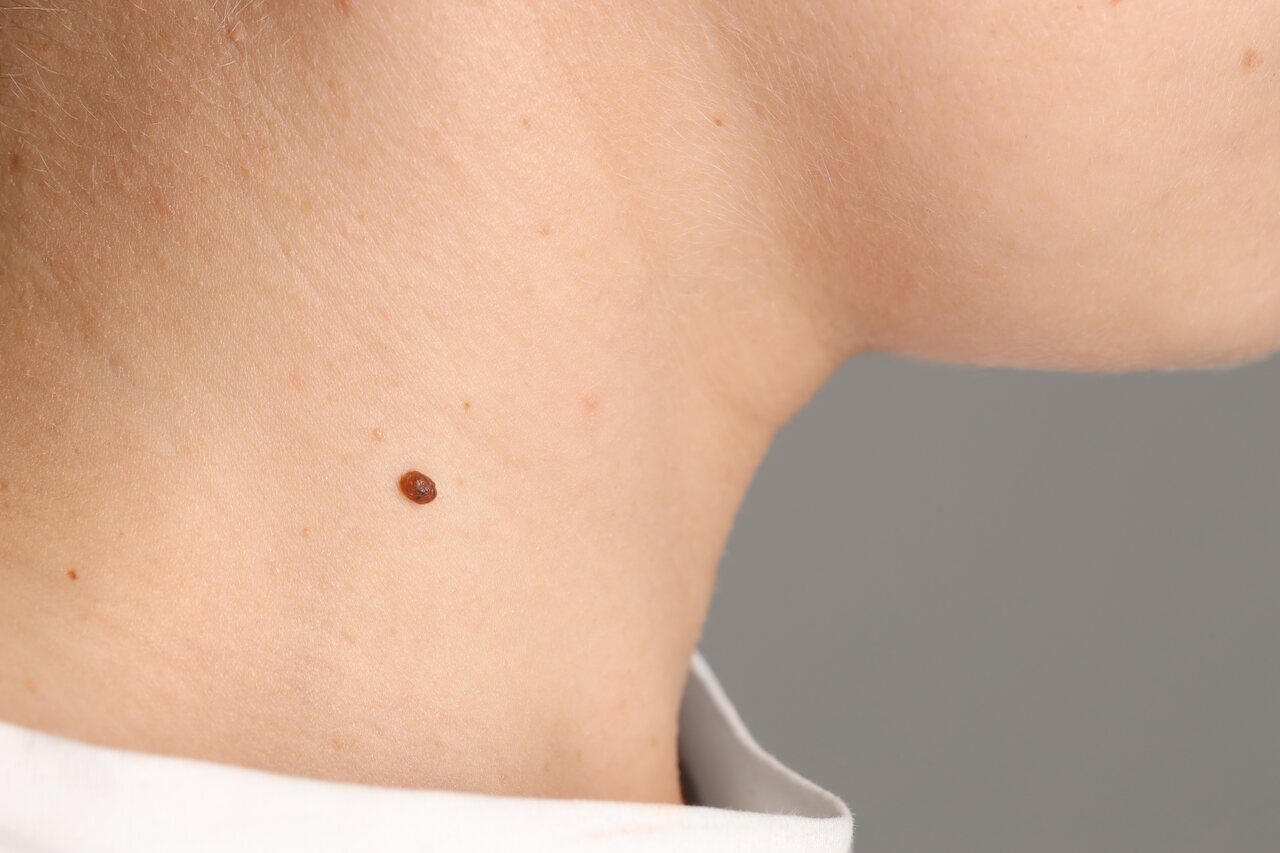 Melanoma metastático: o que é, sintomas e tratamentos