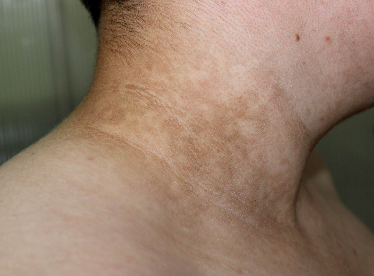 Homem com diabetes e sinal de diabetes acantose nigricans