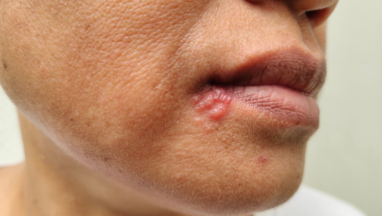 pessoa com herpes