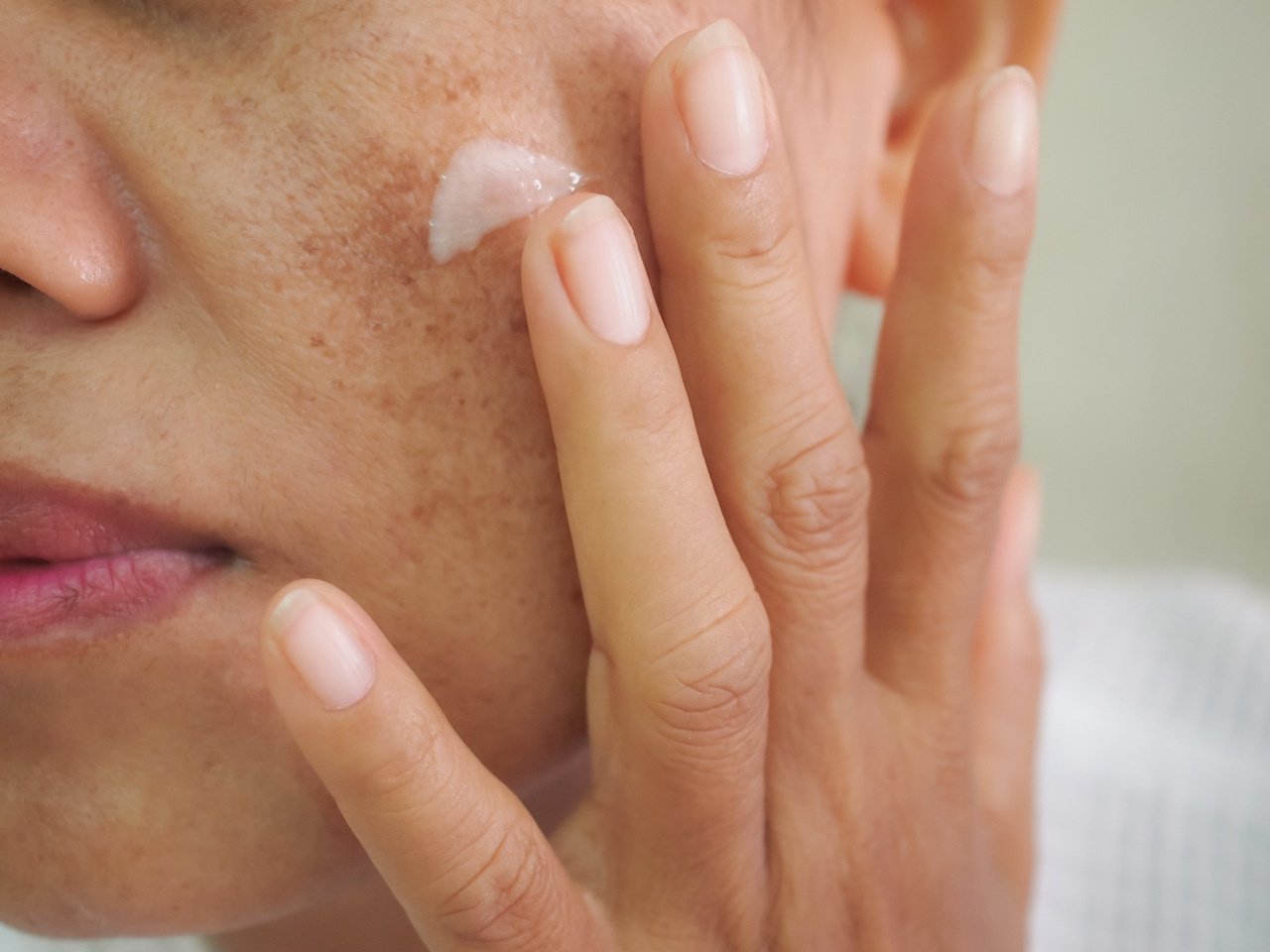 Tipos de manchas na pele fotos: mulher com melasma