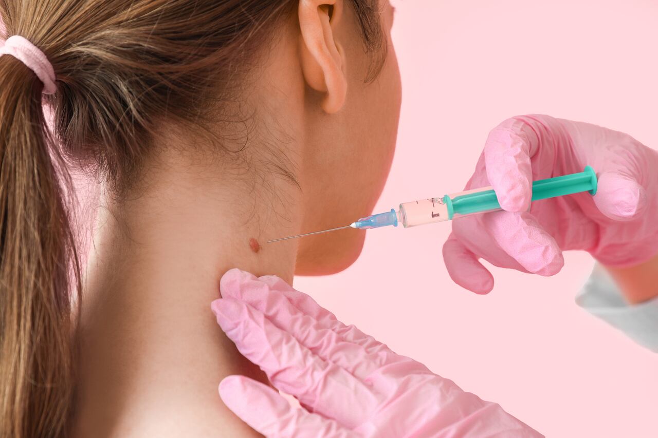 pessoa com melanoma em uma pinta recebendo exame e procedimentos