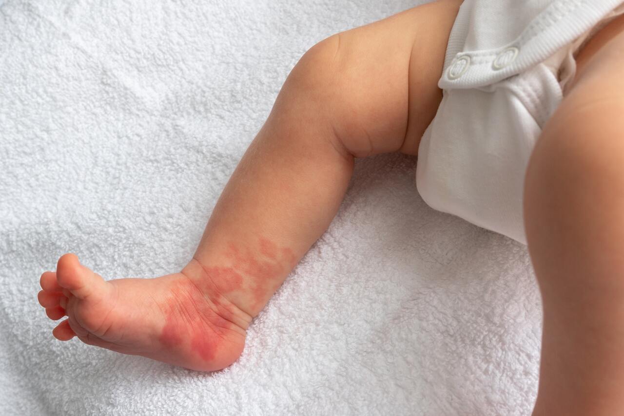 Bebe com mancha na pele causada por hemangioma plano