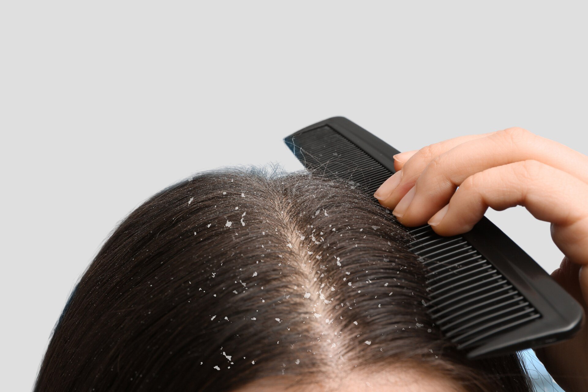 Mulher com caspa seca no cabelo