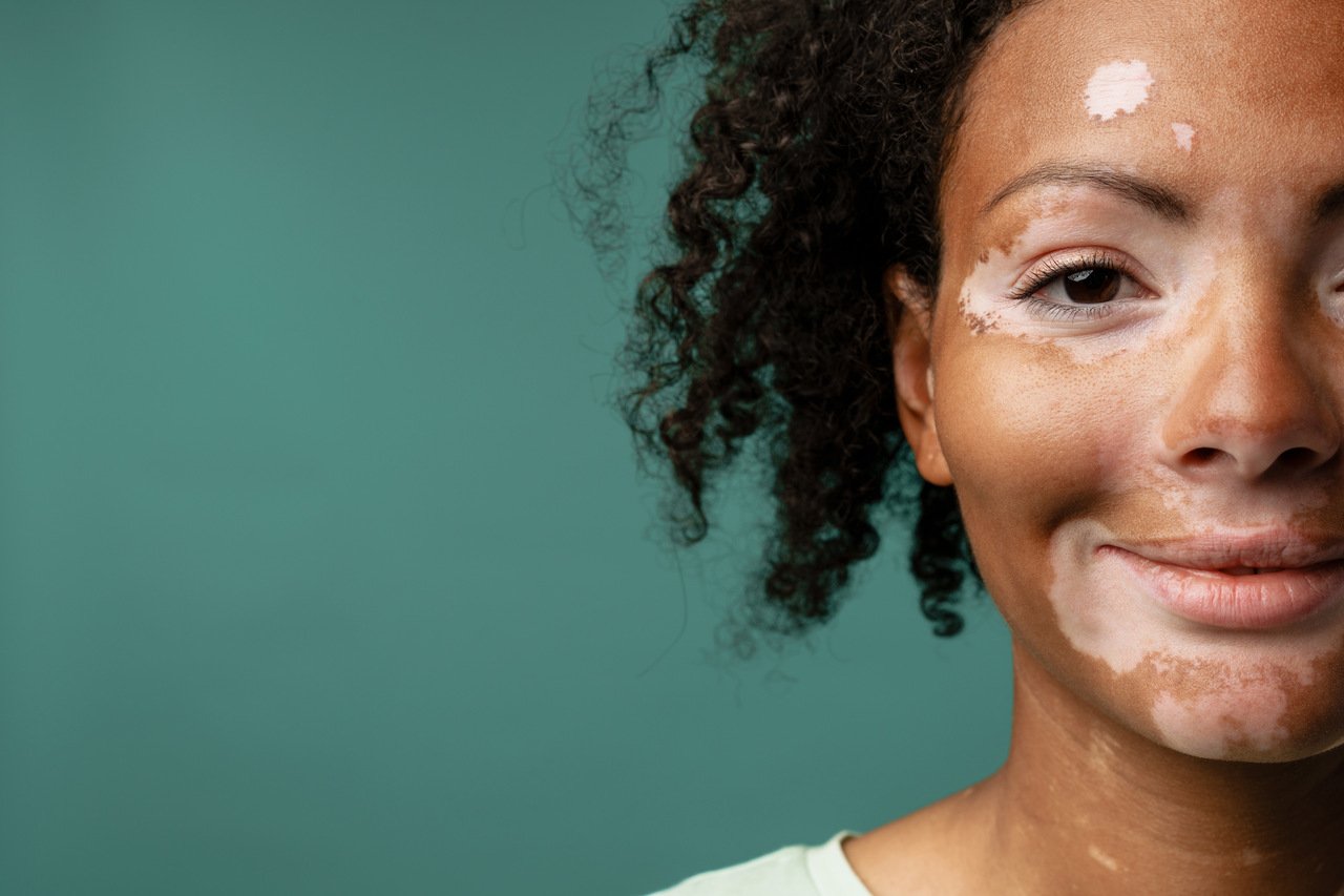 Tipos de manchas na pele fotos: mulher com vitiligo