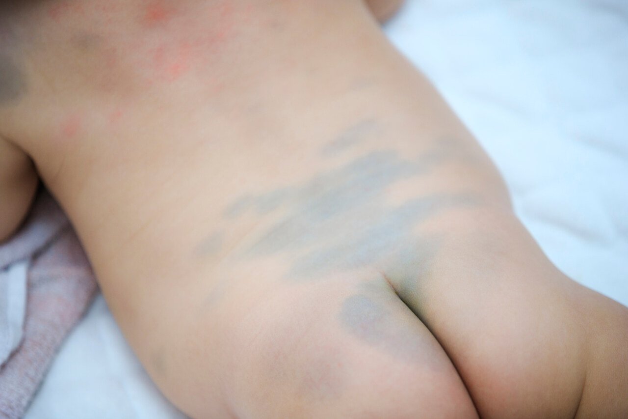 Bebe com mancha na pele causada por hemangioma plano