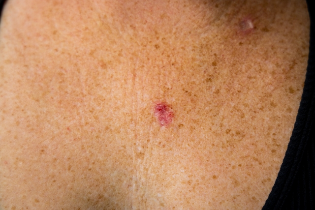 Câncer de pele do tipop carcinoma espinocelular