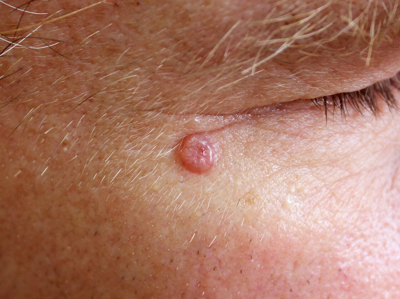 Câncer de pele do tipo carcinoma basocelular