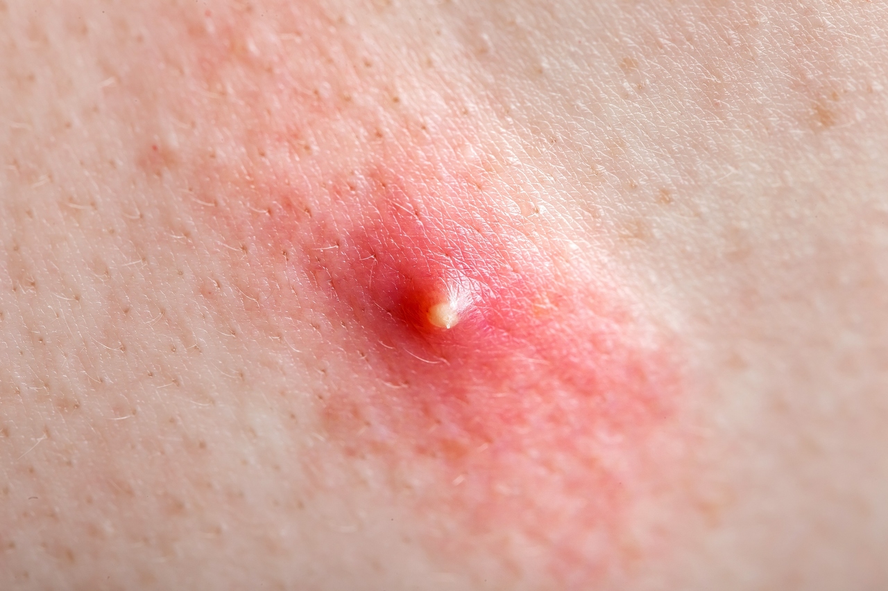 acne de grau 1