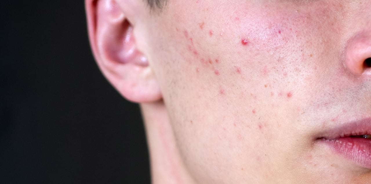 pessoa com acne de grau 2