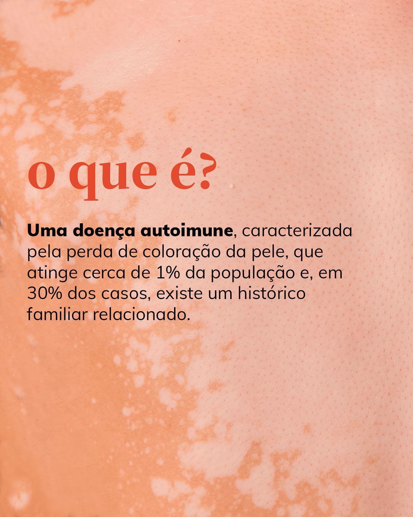 O que é vitiligo