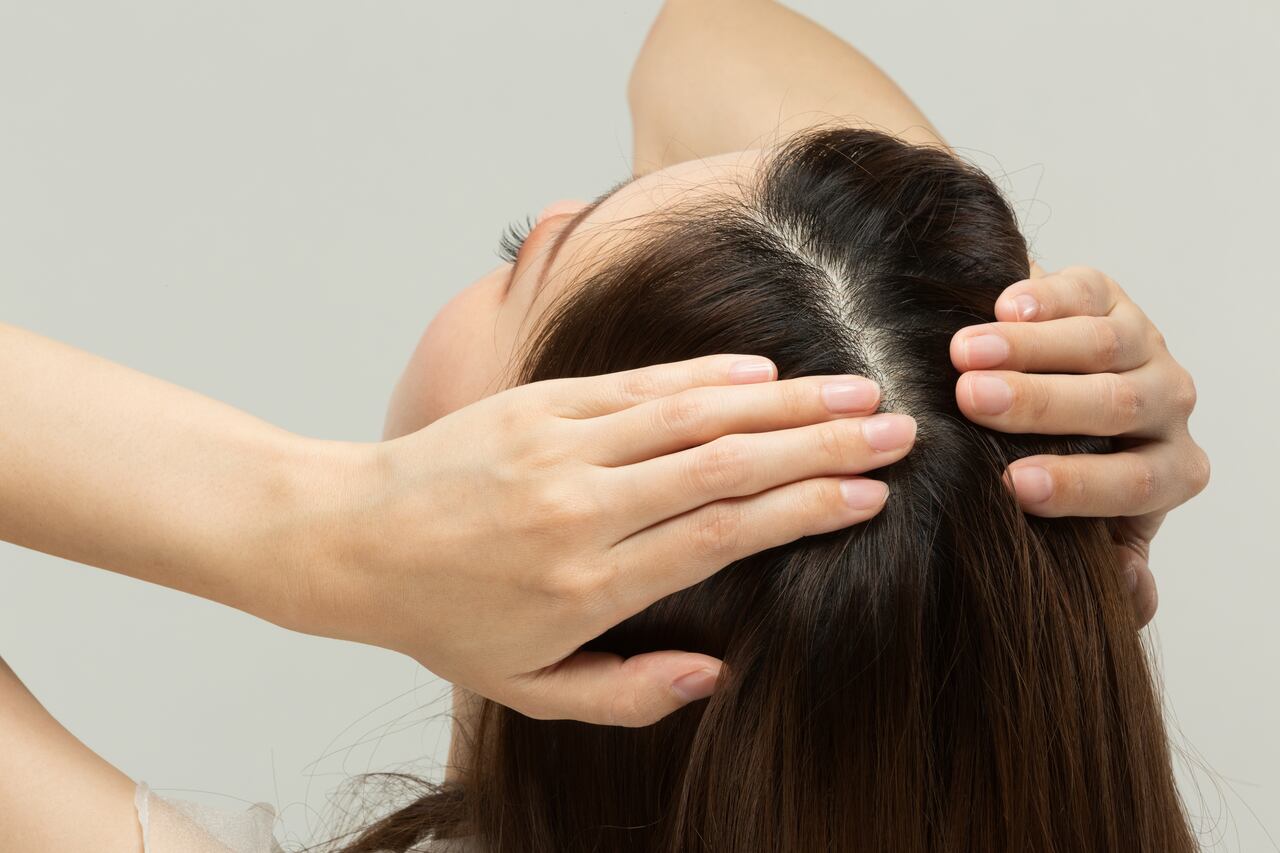 pessoa com dermatite seborreica ou caspa mostrando o couro cabeludo