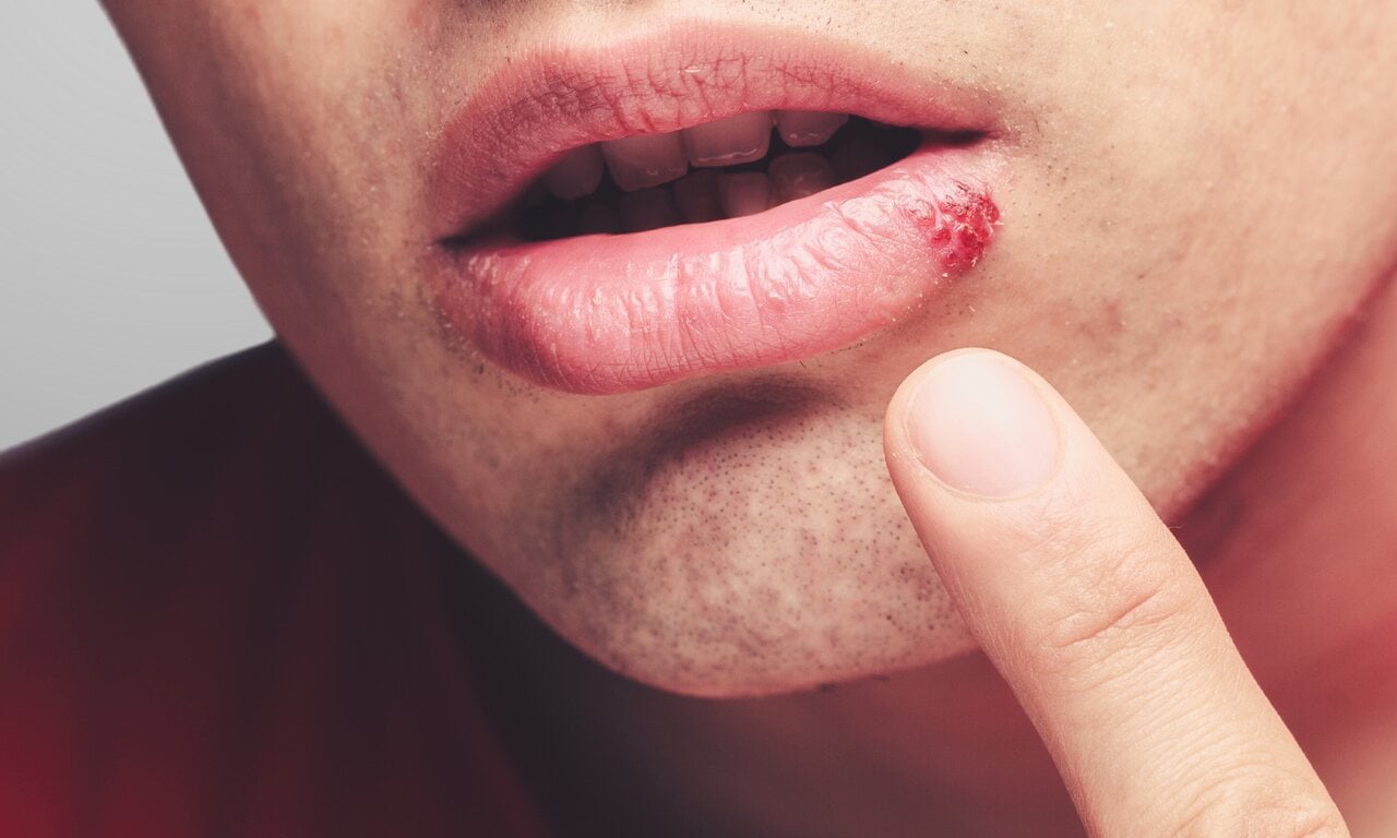 Foto de lábios com uma lesão avermelhada e crostosa no canto, indicando uma ferida ou herpes labial