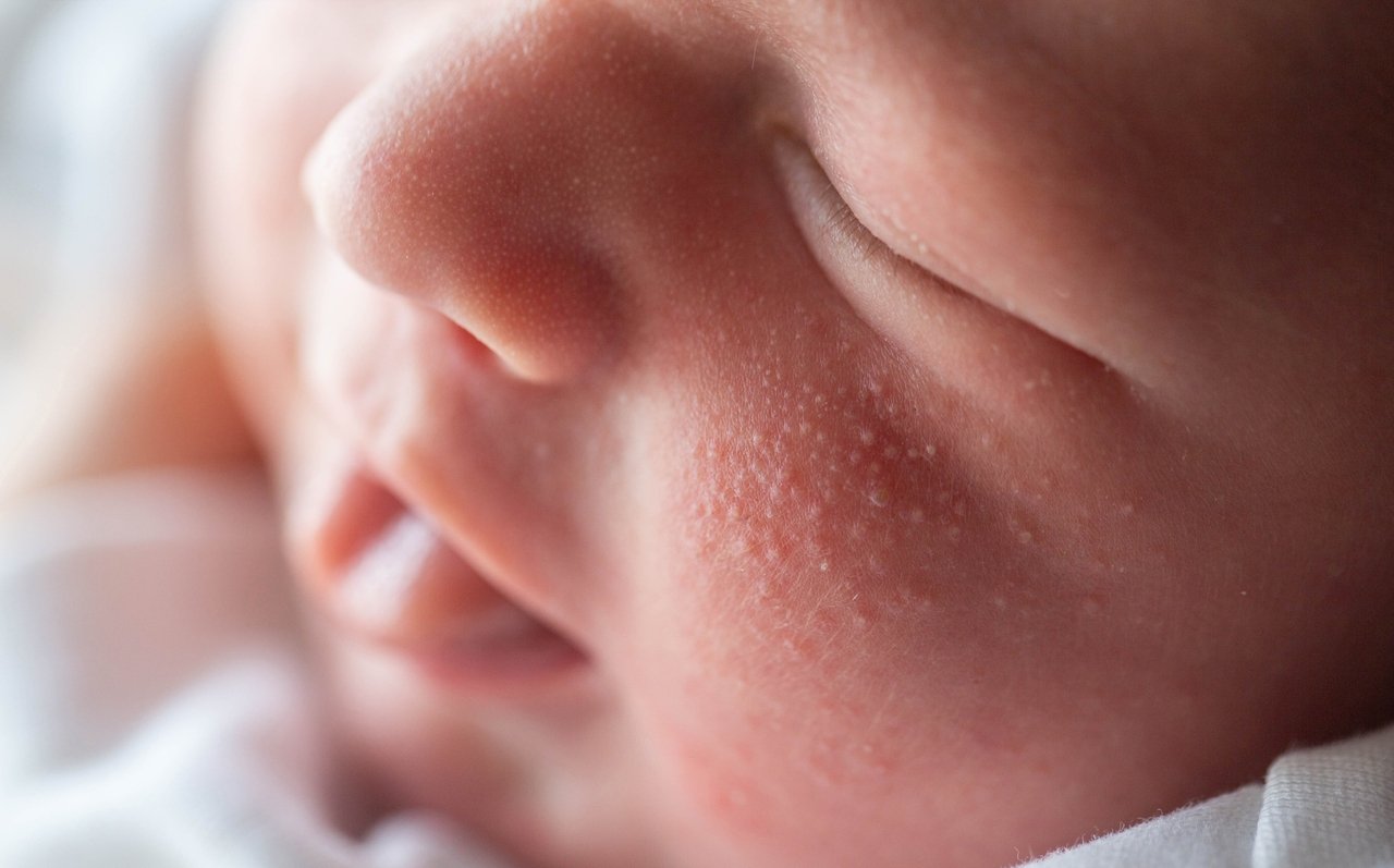 bebê com acne no rosto