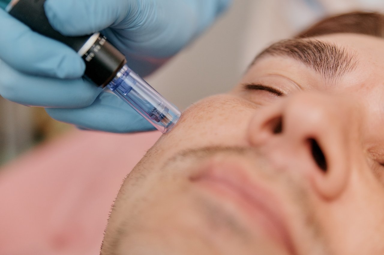 Entenda quanto tempo dura o efeito do microagulhamento