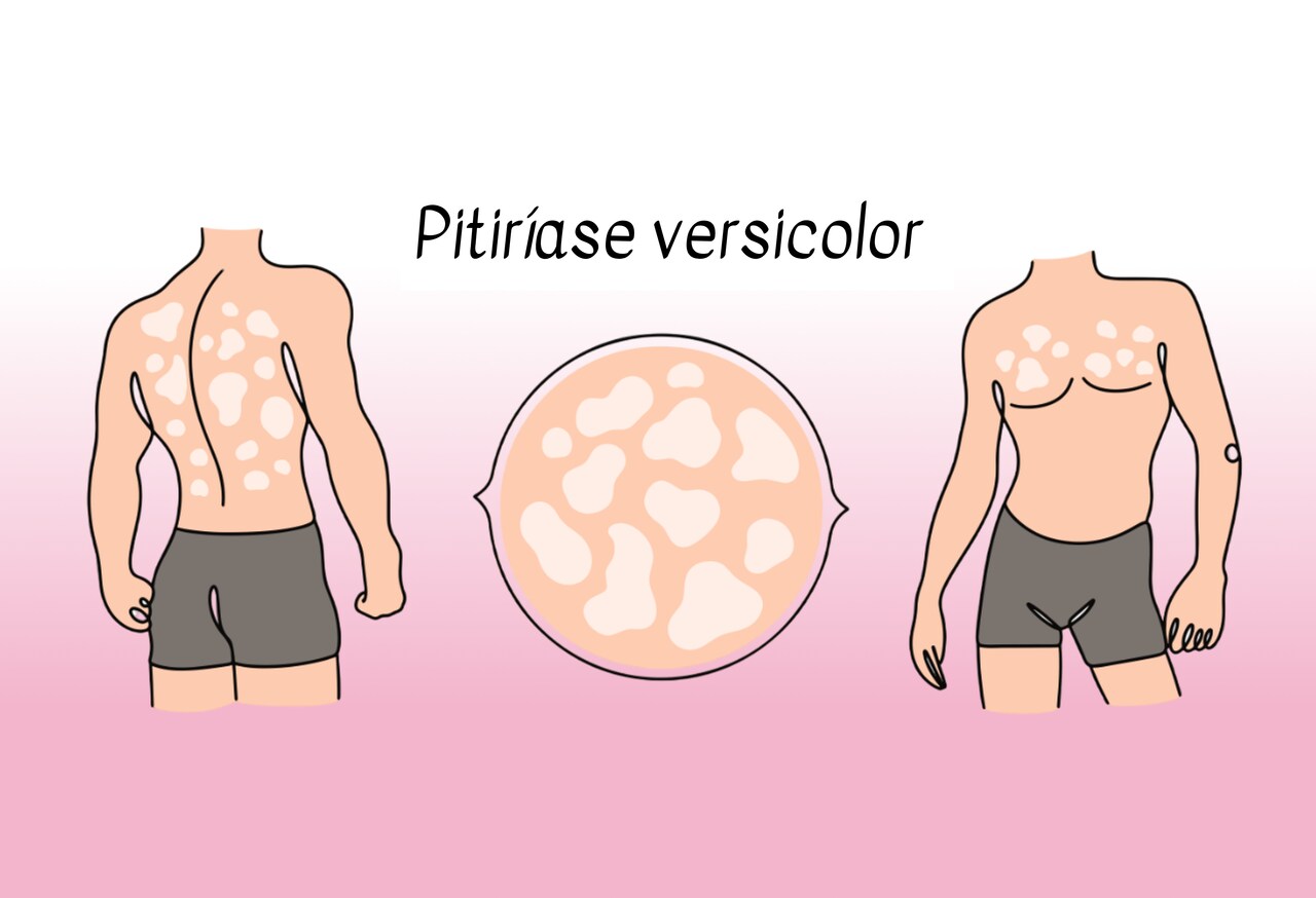 Exemplo de manchas brancas pano branco