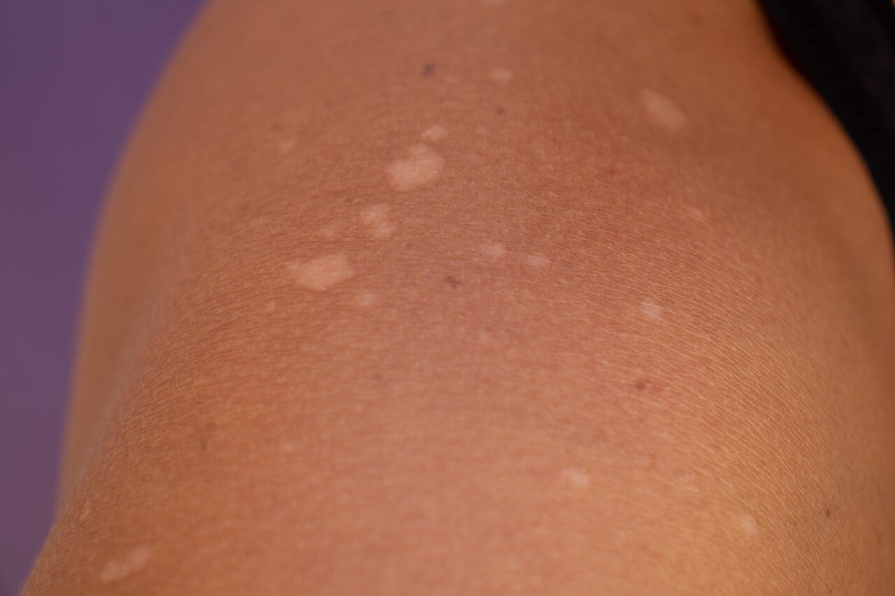 Pele de pessoa com manchas mais claras que o tom natural dela.