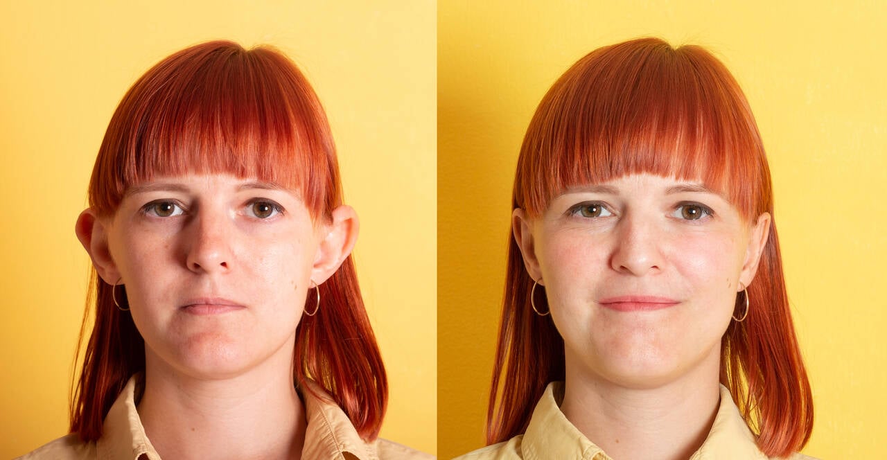otoplastia antes depois