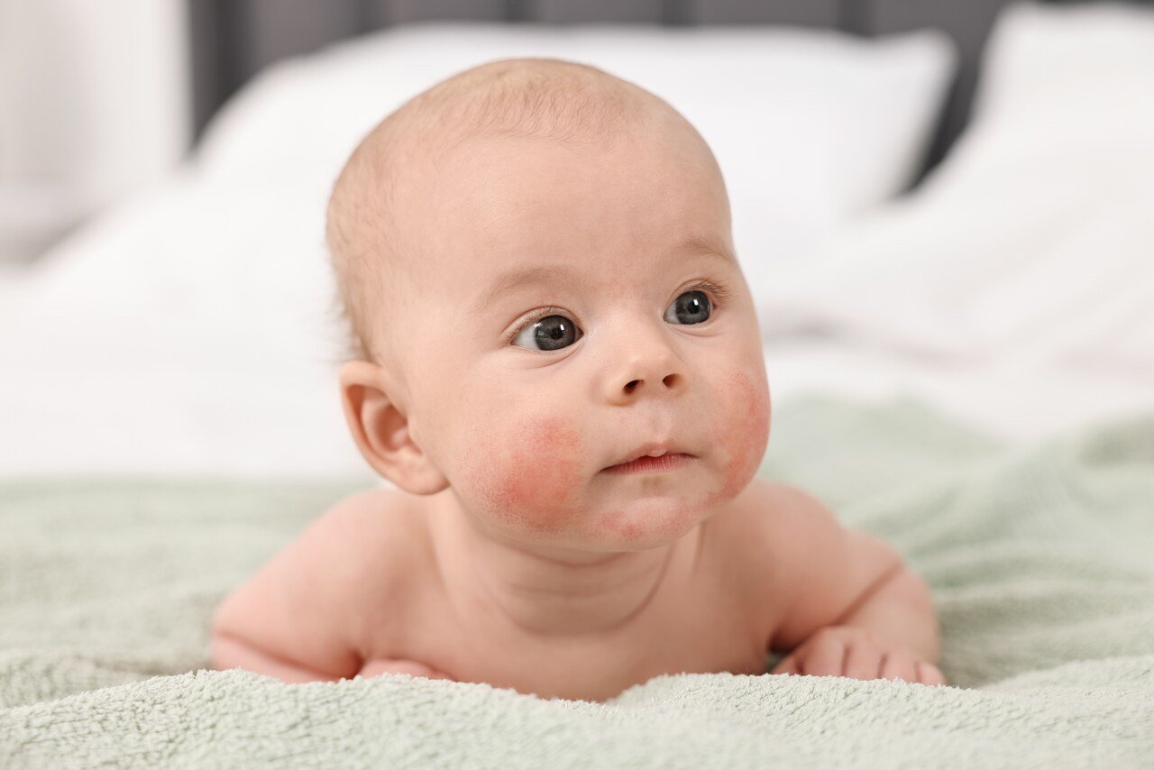 Bebê com alergia ao calor