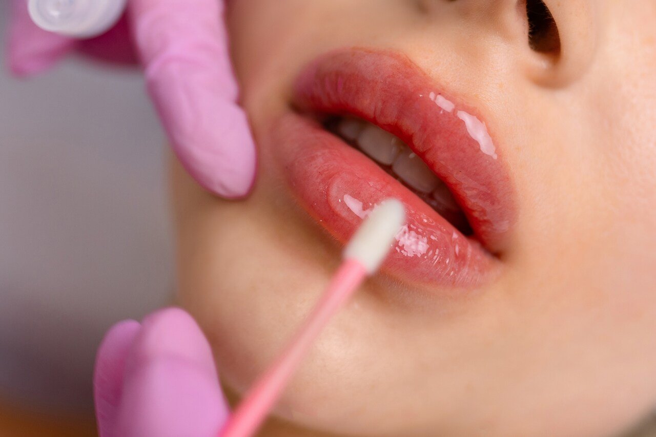 Boca após realizar um preenchimento labial