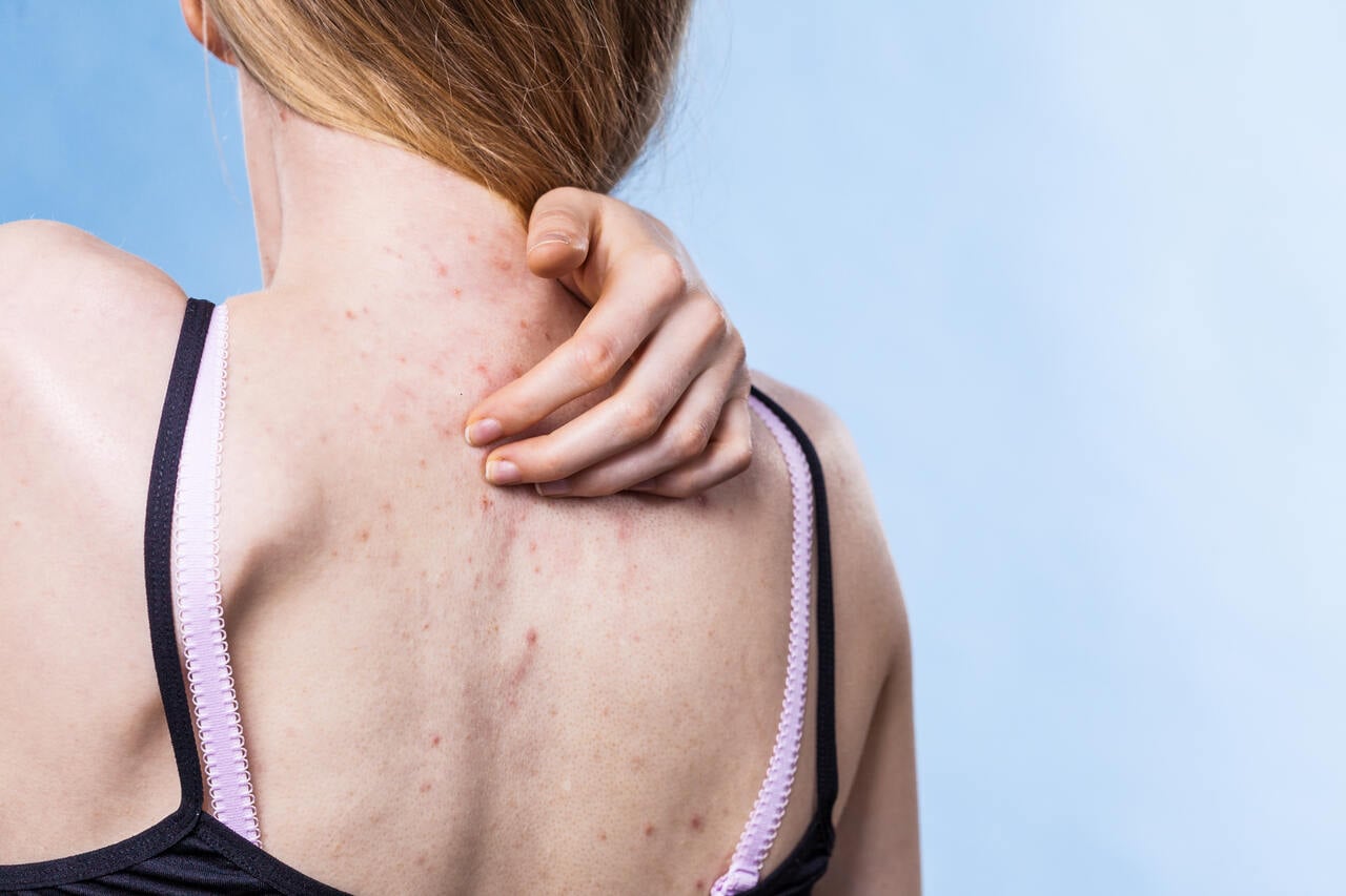 Mulher com marcas de espinhas nas costas