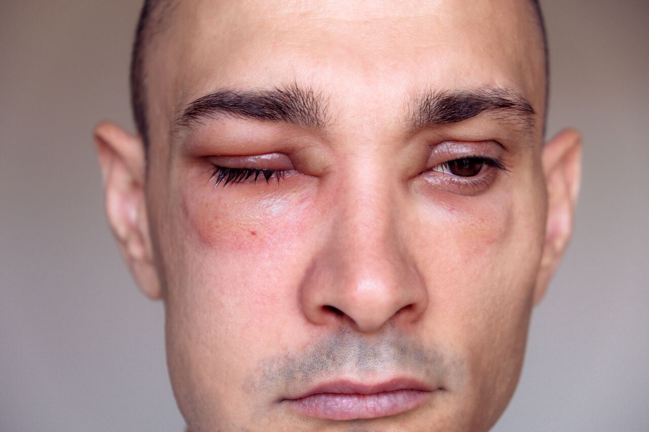 Homem com angiodema no rosto causado por urticária nervosa