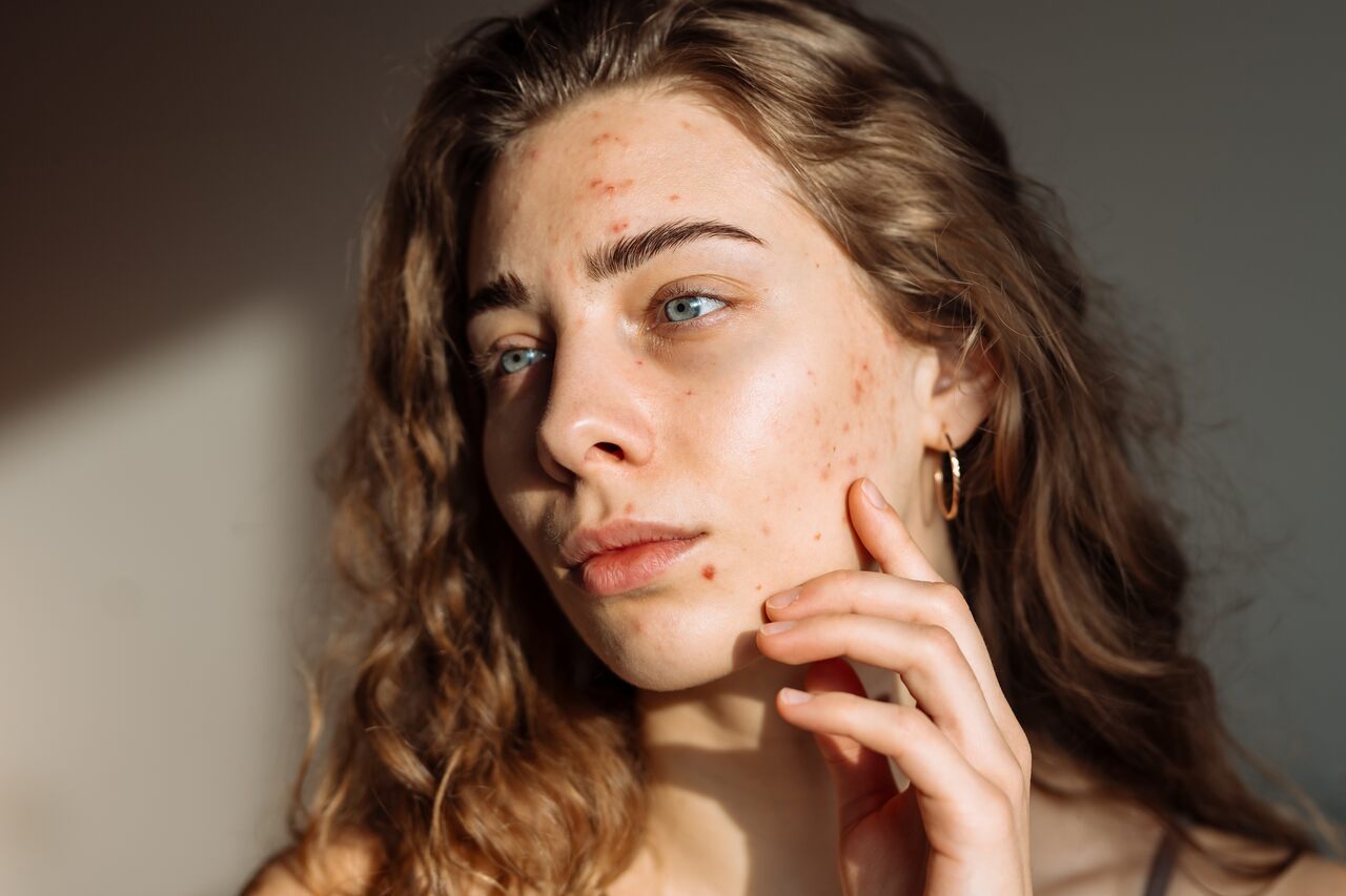 Tipos de manchas na pele fotos: mulher com marcas de acne