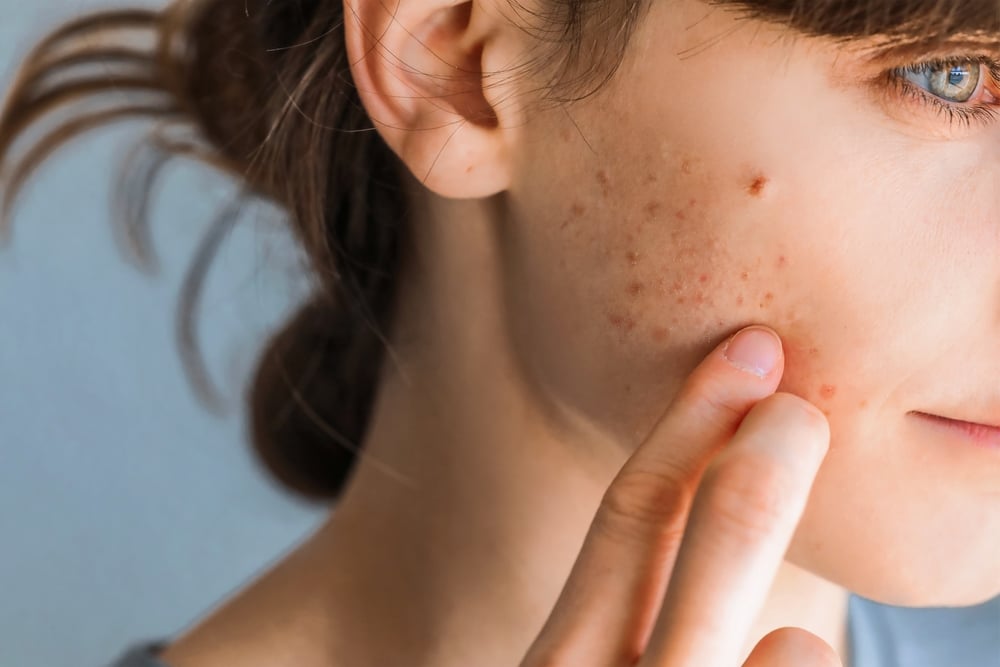 Entenda as causas da acne