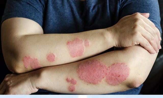 Manchas vermelhas na pele fotos causada por eczema