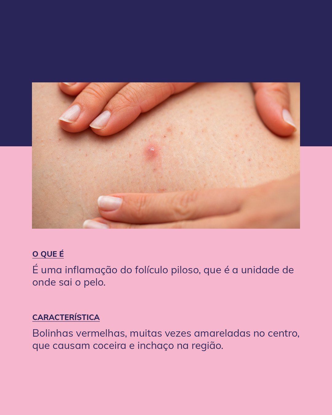 Infográfico com informações sobre o que é foliculite