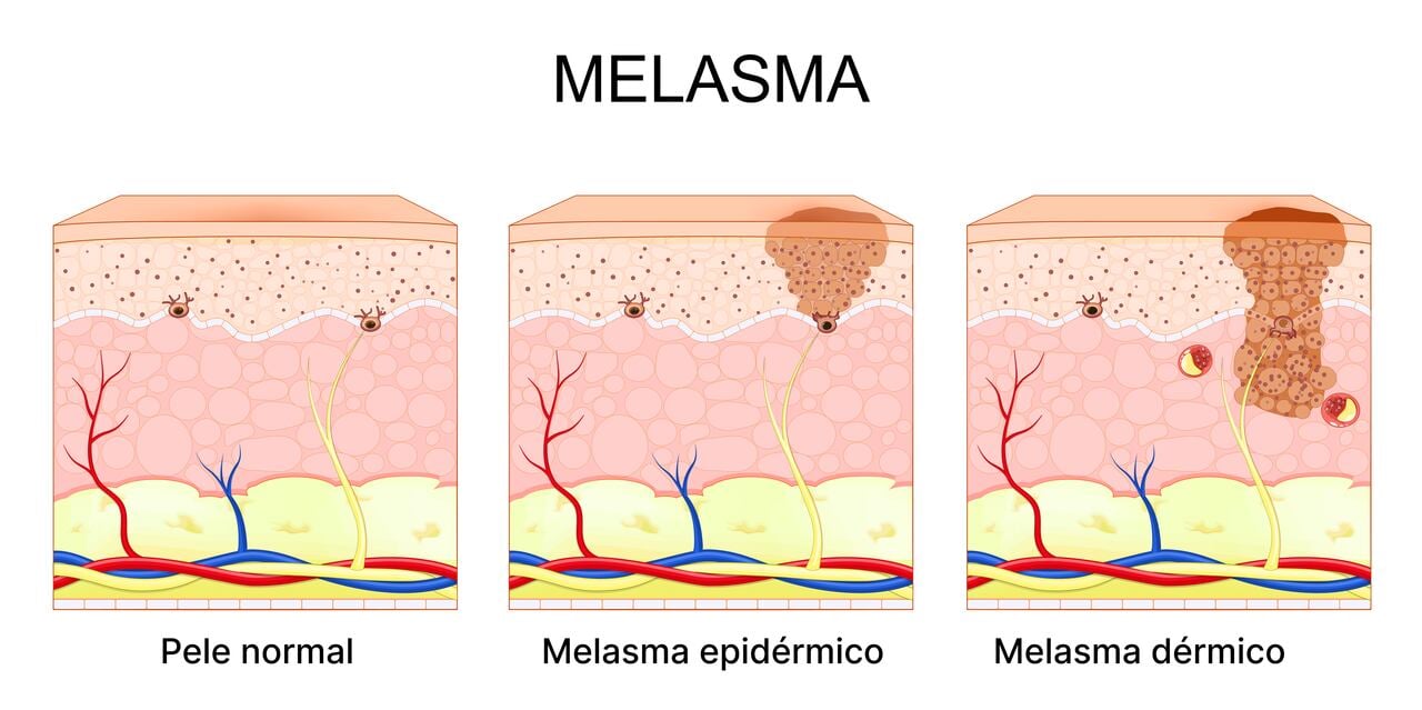 Tipos de melasma