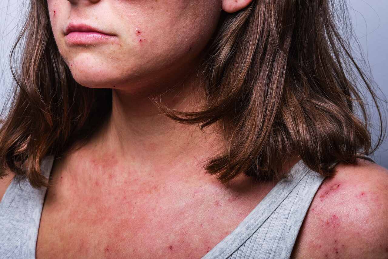 Foto de dermatite atópica