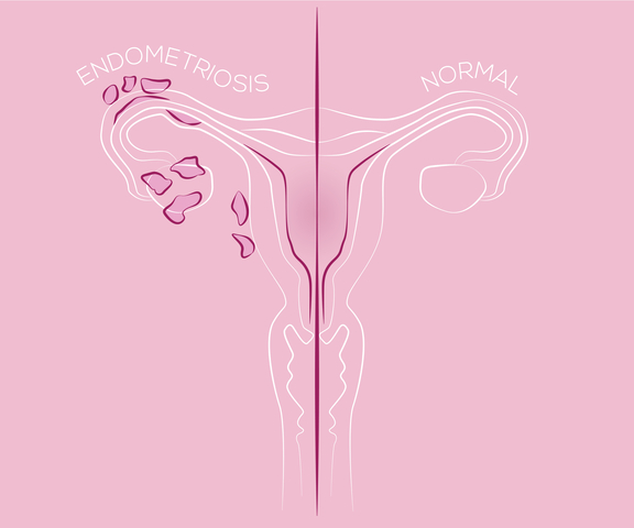 Útero normal e útero com endometriose