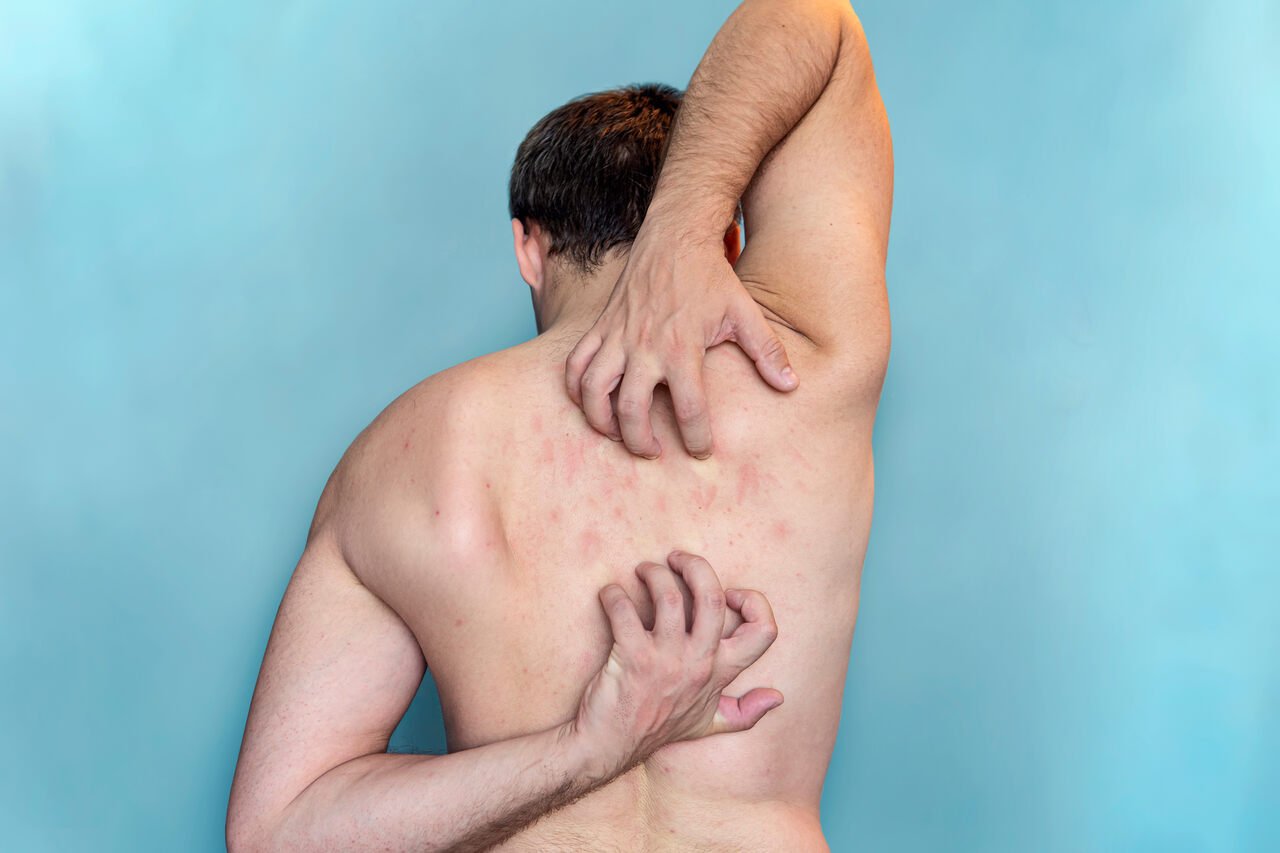 homem com escabiose