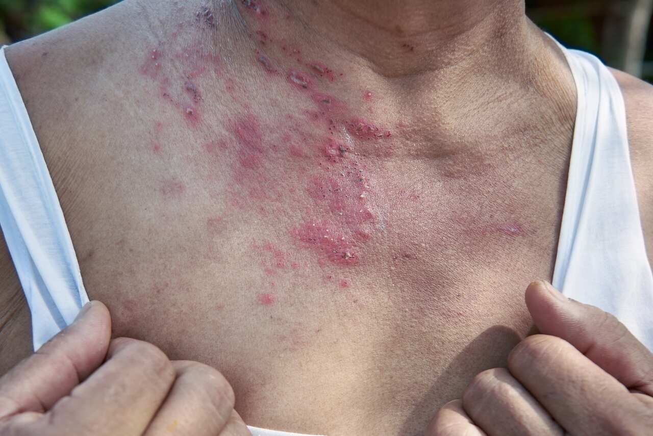 Manchas vermelhas na pele fotos causada por dermatite de contato