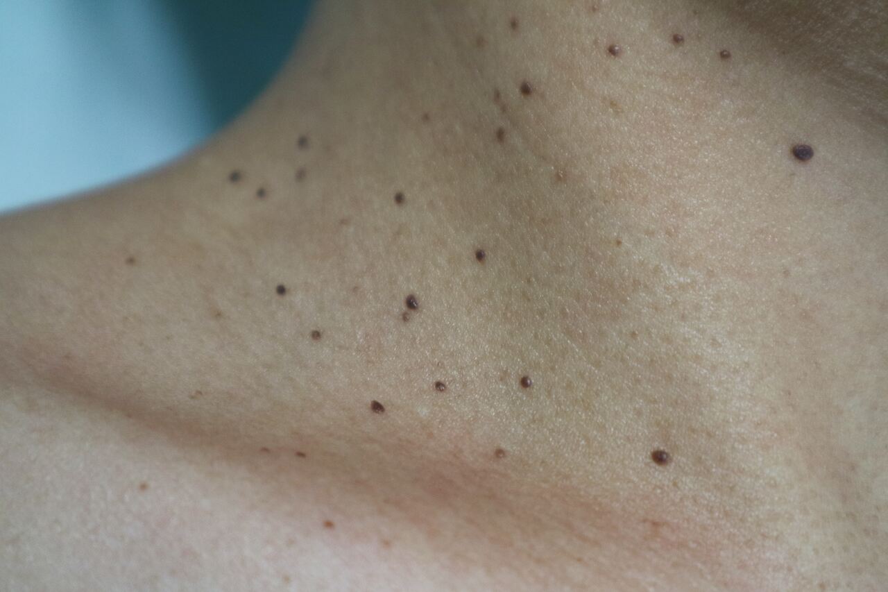 Mulher com dermatose papulosa nigra no pescoço