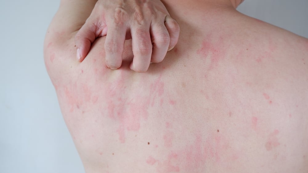 Pessoa com alergia e bolhas na pele