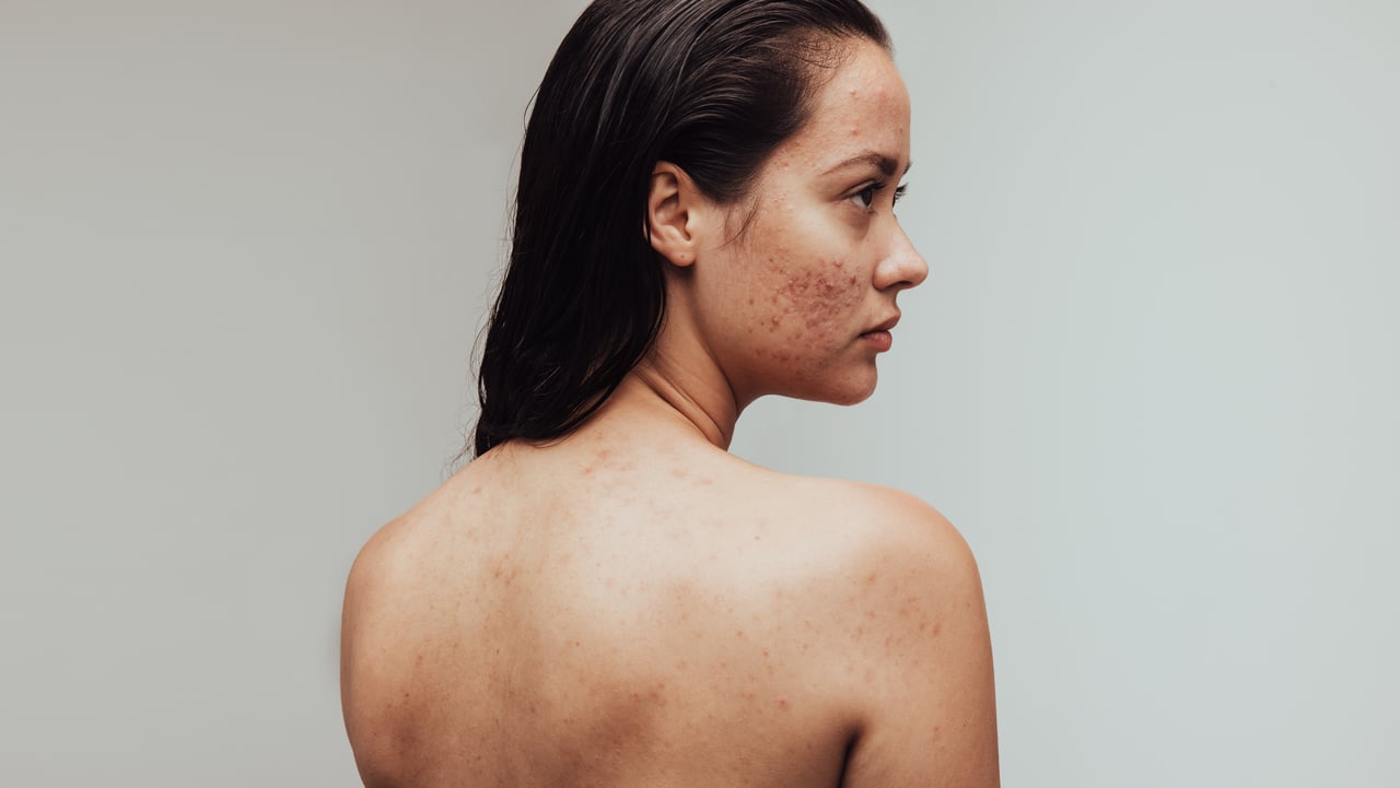 pessoa com acne moderada
