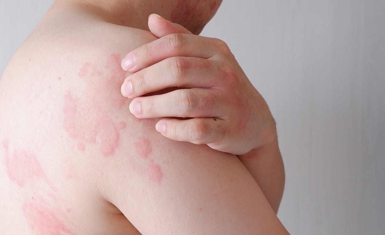 Manchas vermelhas na pele fotos causada por urticaria