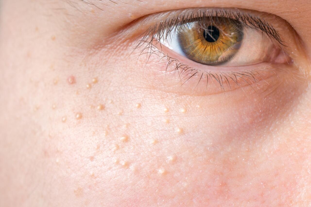 Milium no rosto ao redor dos olhos