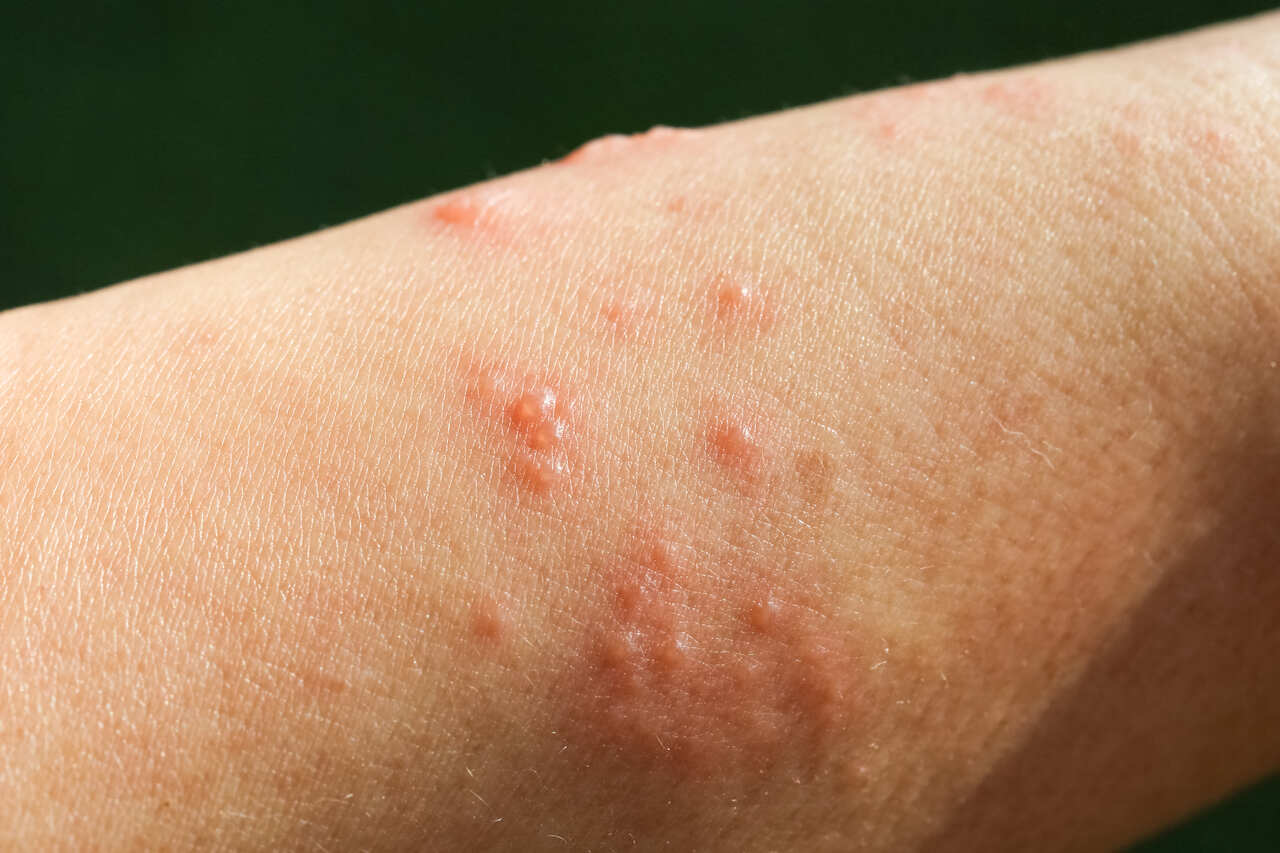 fotos de alergia na pele que coçam causadas por penfigo