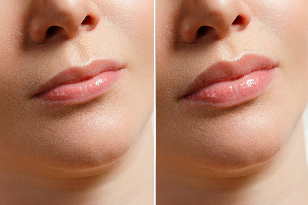 Preenchimento labial antes e depois