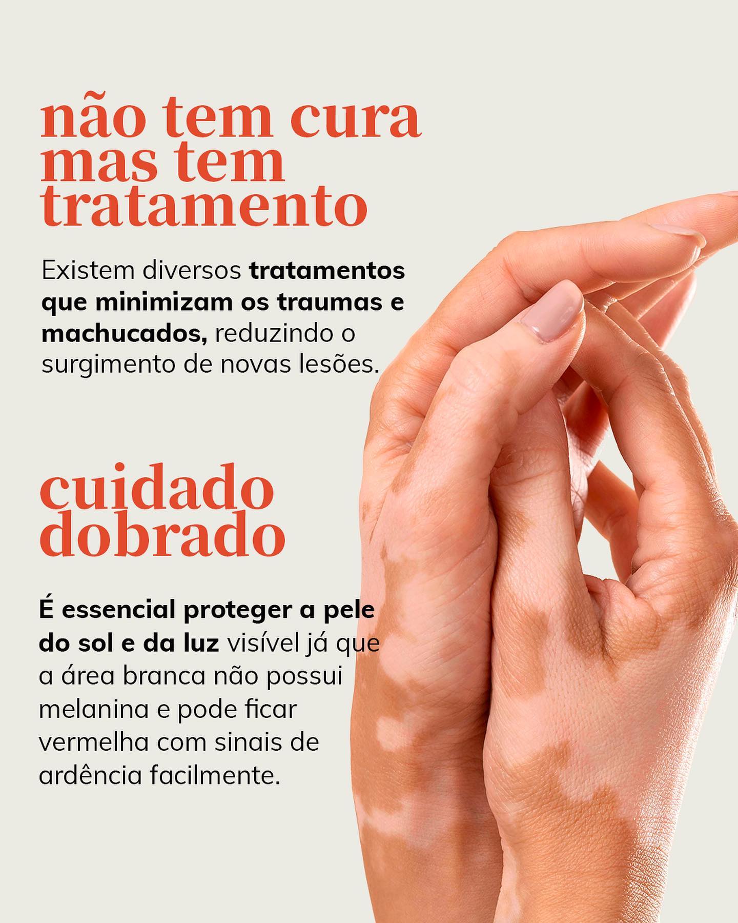 Vitiligo tem cura?