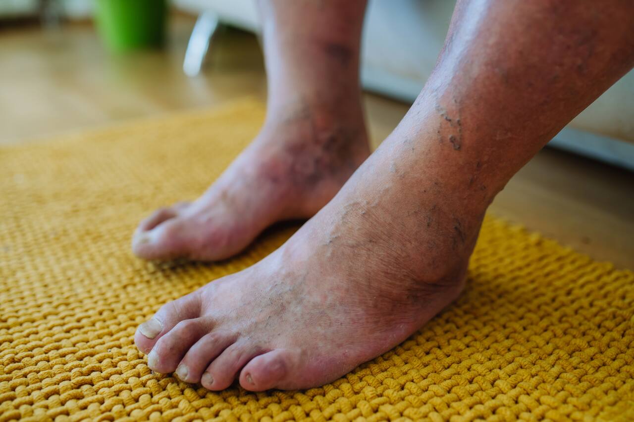 Pessoa com com diabetes e sinal de diabetes Dermiopatia diabética